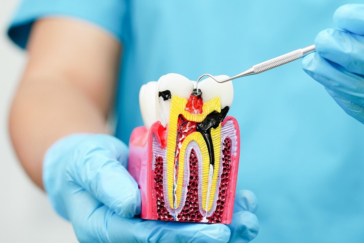 root canal treatment costs in hyderabad